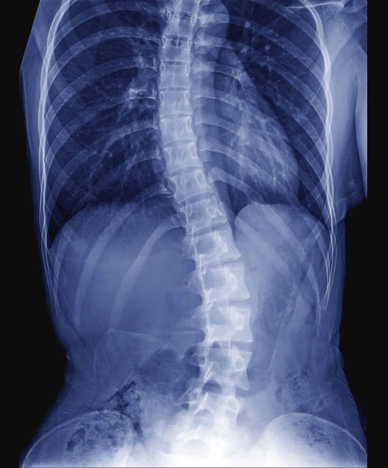 X-ray,Image,Of,Teenager,Patient,Spine,Show,Scoliosis,And,Spinal – Chiropractic X-Rays in Lehi Utah