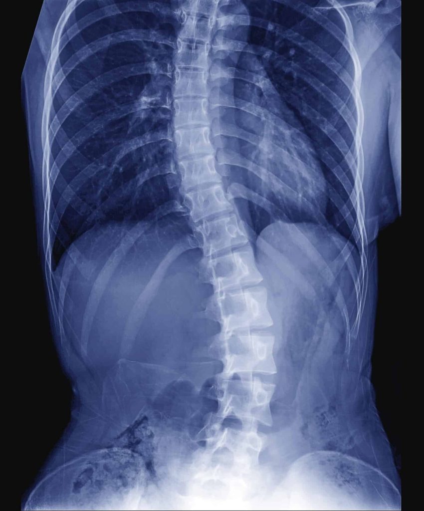 X-ray,Image,Of,Teenager,Patient,Spine,Show,Scoliosis,And,Spinal – Chiropractic X-Rays in Lehi Utah